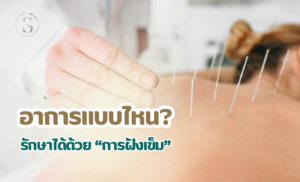 การฝังเข็ม คืออะไร? ทางเลือกการรักษาอาการปวดโดยไม่ต้องผ่าตัด