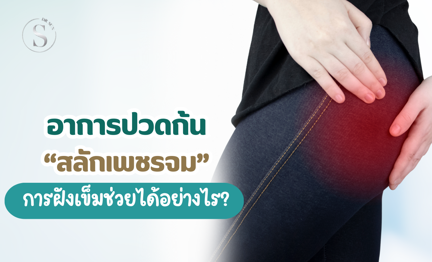 อาการปวดก้นจากสลักเพชรจม ทำงานไม่ได้? รักษาได้โดยไม่ต้องผ่าตัด