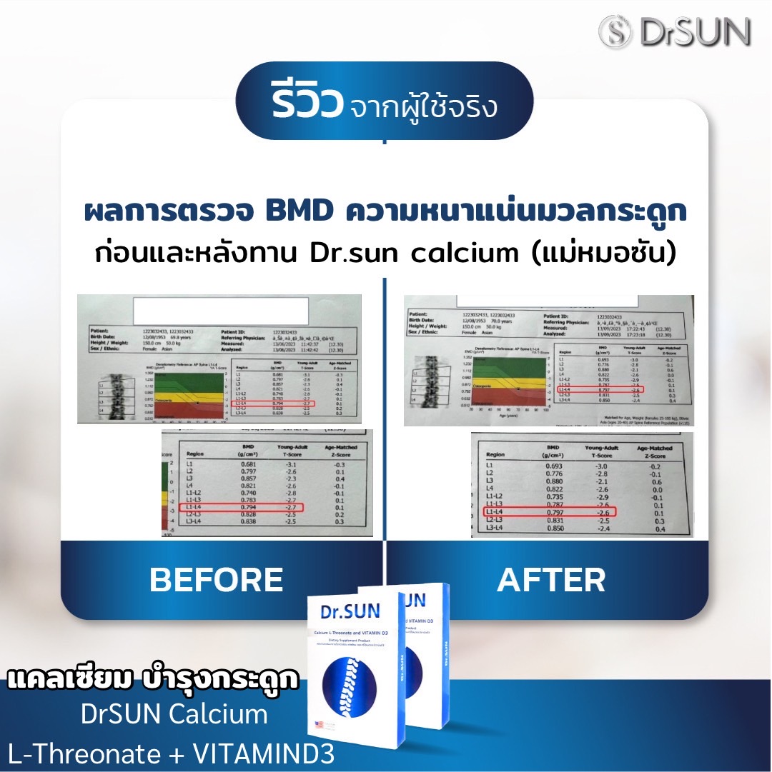 ผลตรวจ BMD ก่อน-หลัง ของคุณแม่หมอซัน
